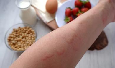 Utility of xMAP For Multiplex Testing, Suspected Allergy, and Potential Cross-Reactivities in Food Samples (Food Testing)